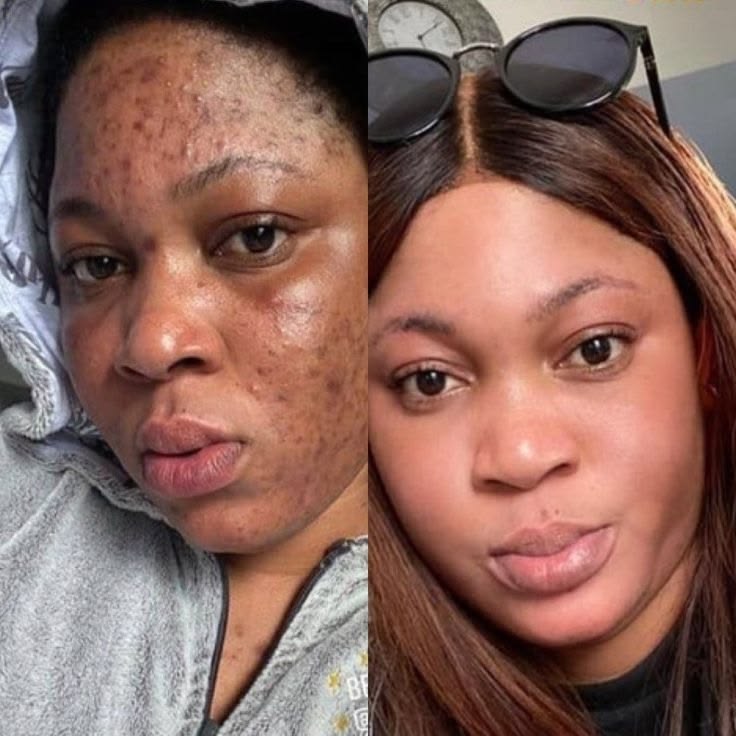 Chisom N. before and after