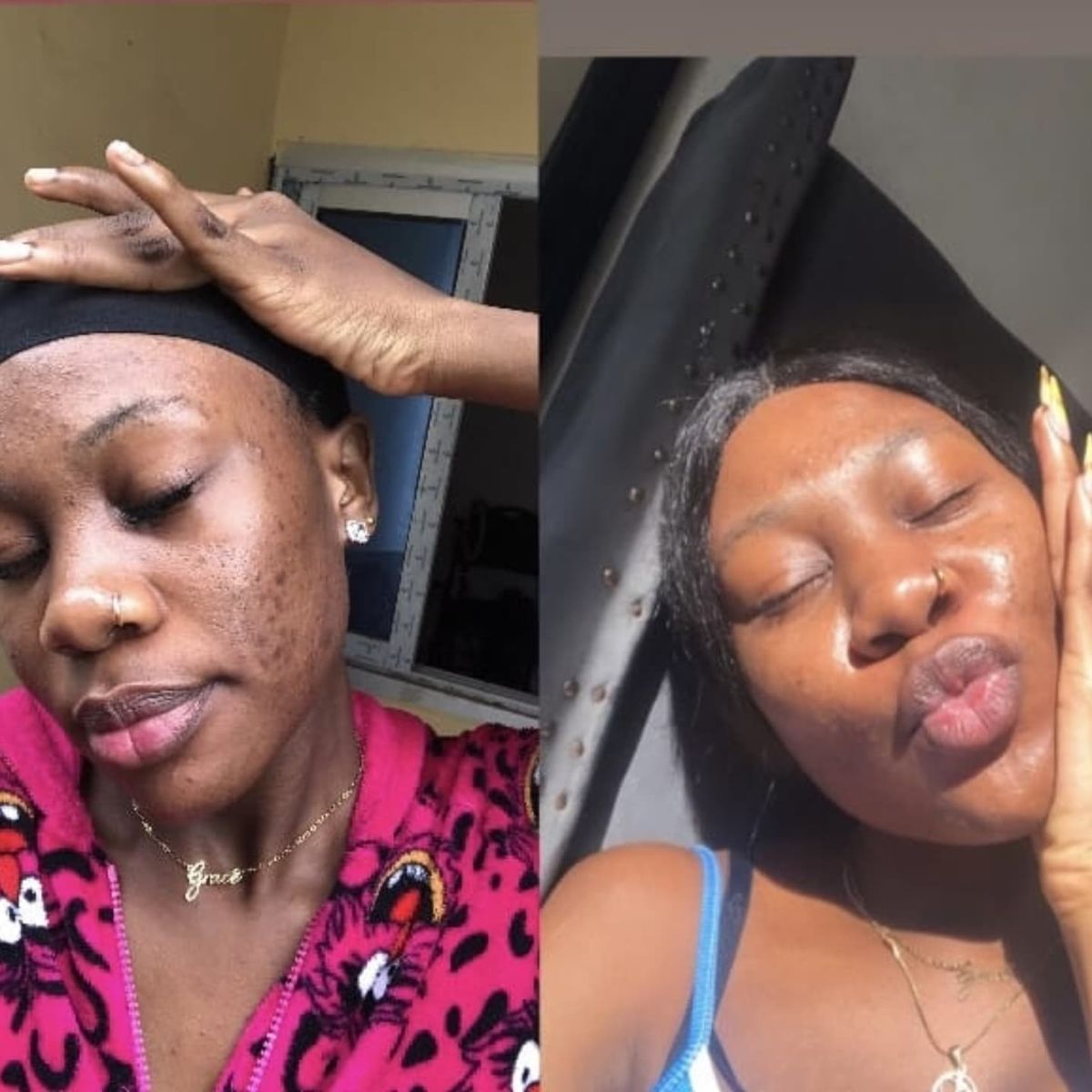 Amaka C. before and after